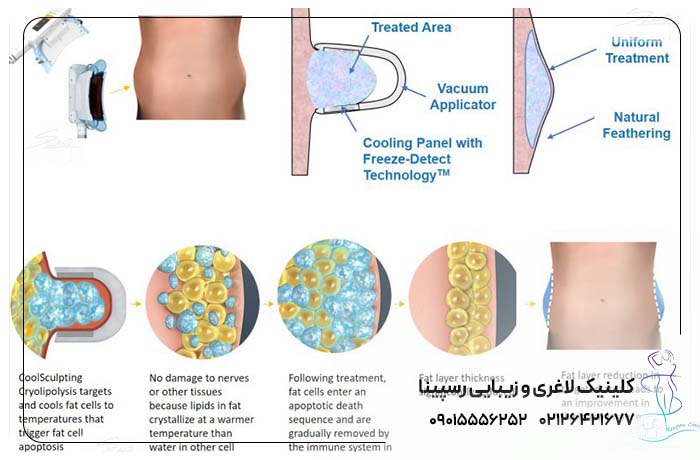 کرایولیپولیز از کجا آمده است